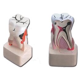 Modello Patologia Dentale 1 pz.